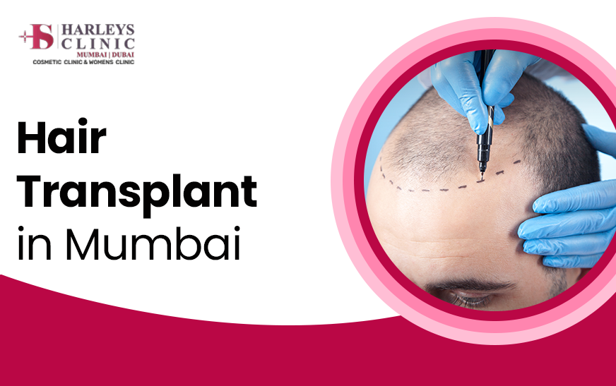 Essential Facts About Hair Transplant Surgery in Mumbai