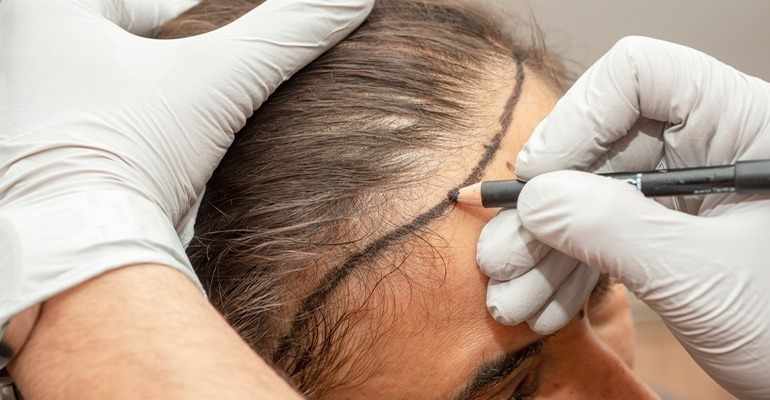 Female Hair Transplant in Mumbai – Safe, Natural & Permanent Results!