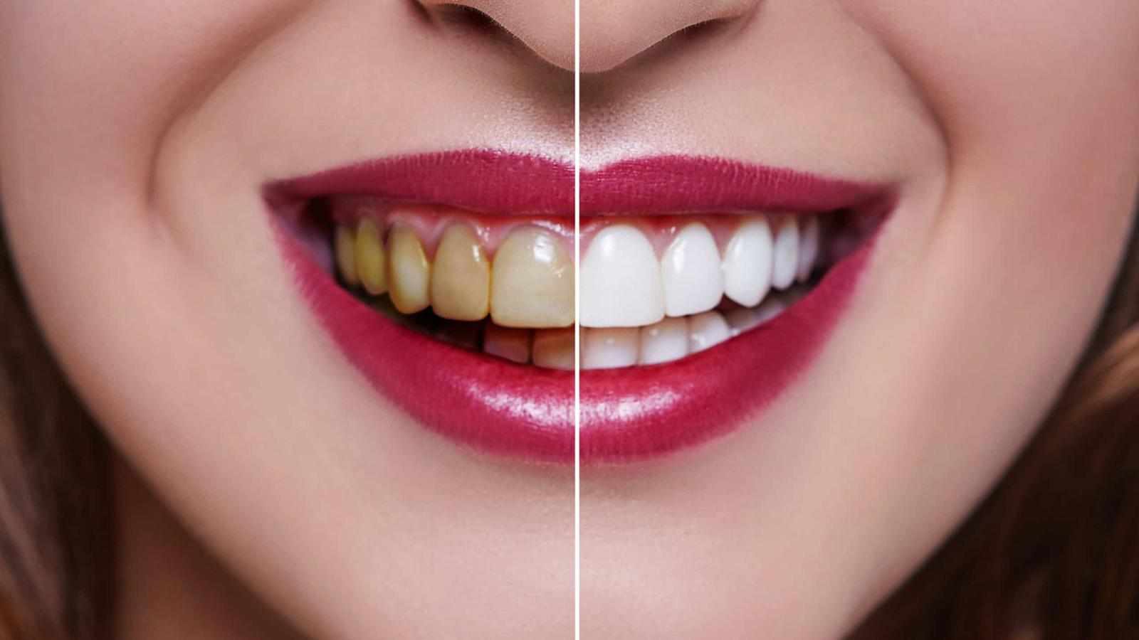 Can Teeth Be Permanently Whitened?