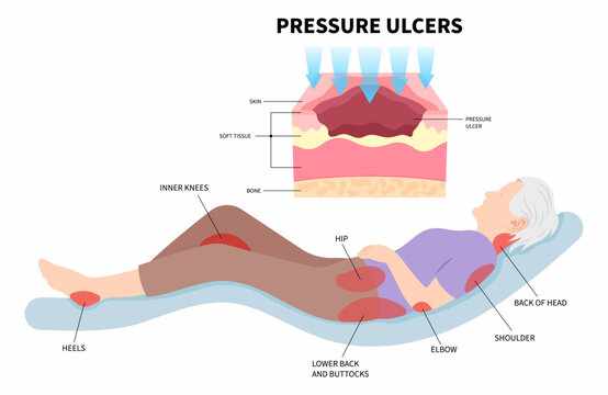 Managing Chronic Pressure Ulcers: A Practical Guide to Skin Care and Recovery