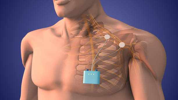 Peripheral nerve stimulation therapy in shoulder area Peripheral nerve stimulation therapy (PNS) is a medical technique that involves the use of electrical stimulation to modulate or block the transmission of pain signals along peripheral nerves. It can be used for various conditions, including those affecting the shoulder area. This therapy aims to provide pain relief, improve function, and enhance the patient's quality of life. Here's how PNS may be applied to the shoulder area. sholder orthopedics stock pictures, royalty-free photos & images