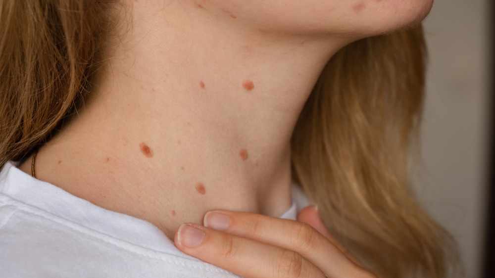Are Skin Tags Contagious? Common Questions Answered