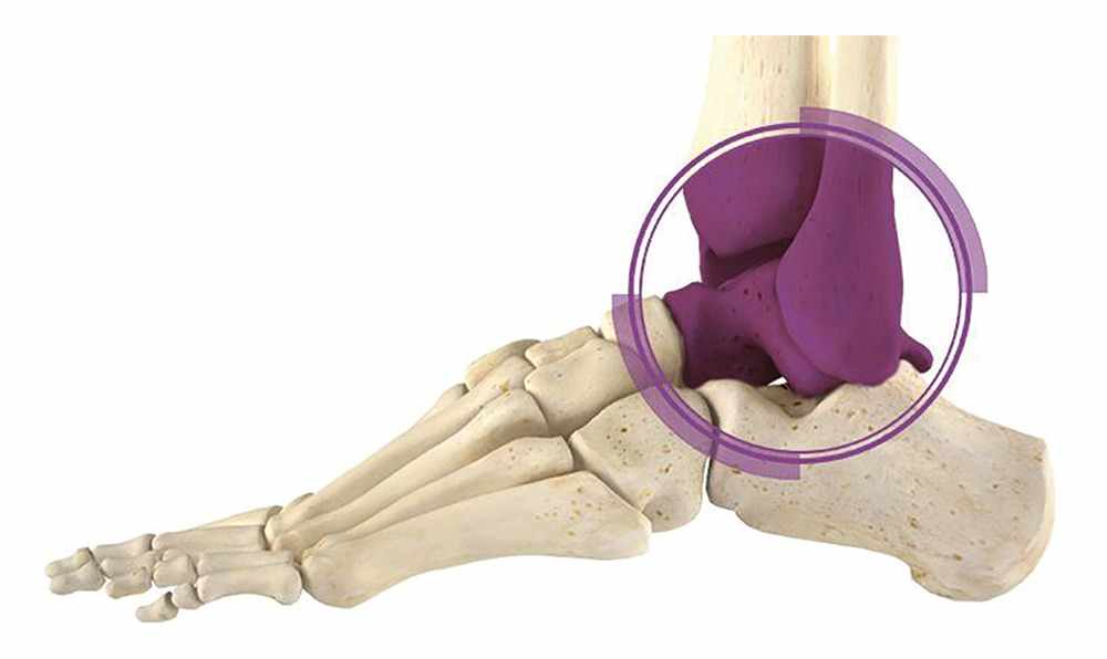 Understanding Total Ankle Replacement Surgery in Delhi and Recovery