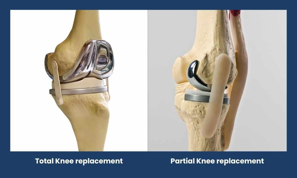 Partial vs Total Knee Replacement Surgery in Delhi: Expert Insights from Orthopaedic Surgeons
