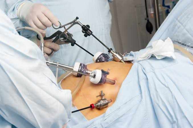 What is a Cholecystectomy?