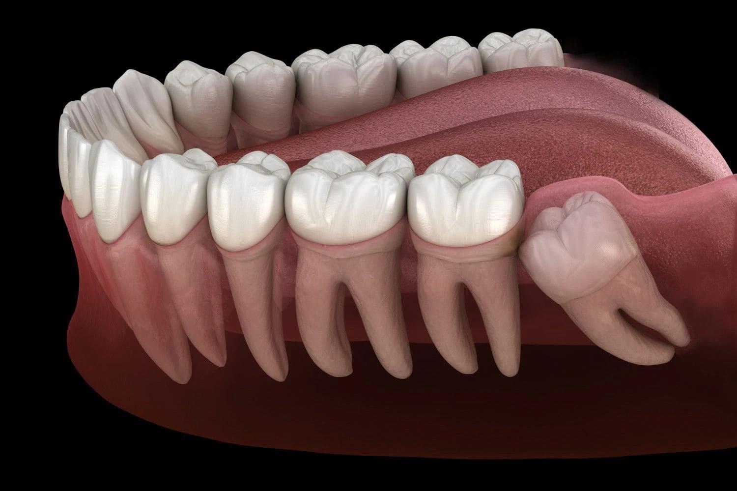 Understanding the Process of Wisdom Tooth Removal in Wanowrie