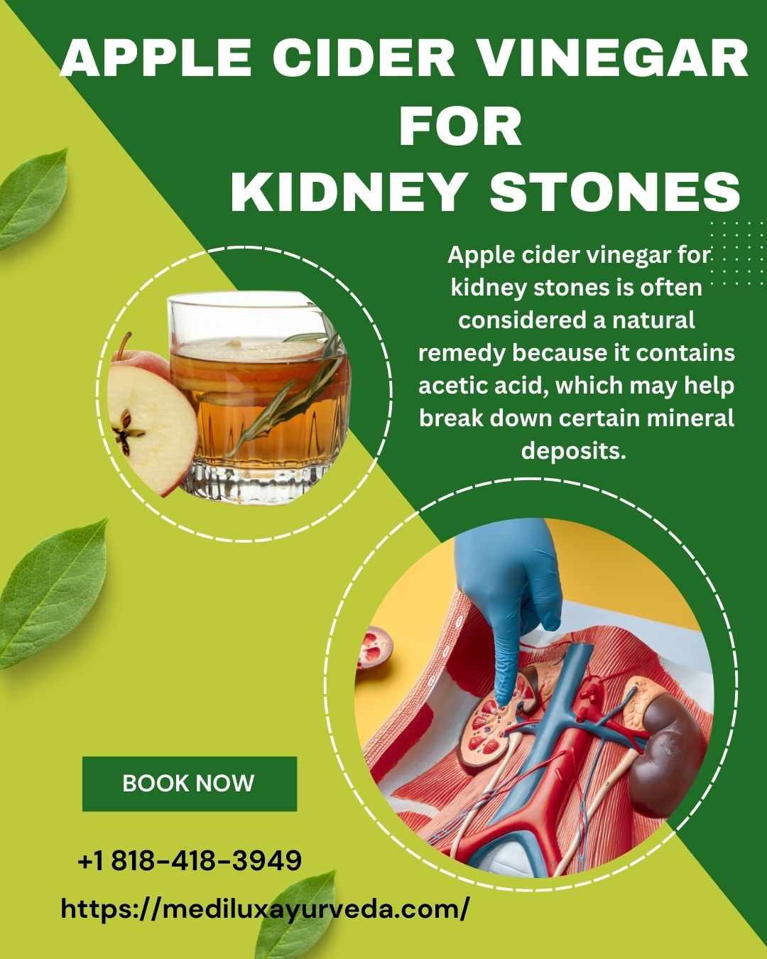 Apple Cider Vinegar for Kidney Stones: Natural Remedy or Myth?