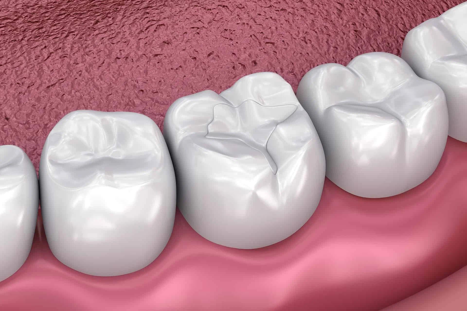 Restoring Your Smile Naturally with Tooth Colored Filling in Bhandara