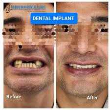 Full Mouth Dental Implants: The Ultimate Guide to Permanent Teeth Replacement