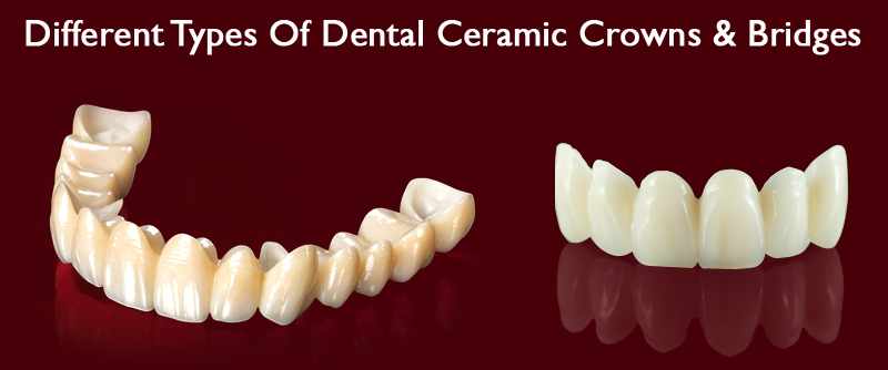 Smile Makeover with Ceramic Crowns: Cost in India & What Influences Pricing