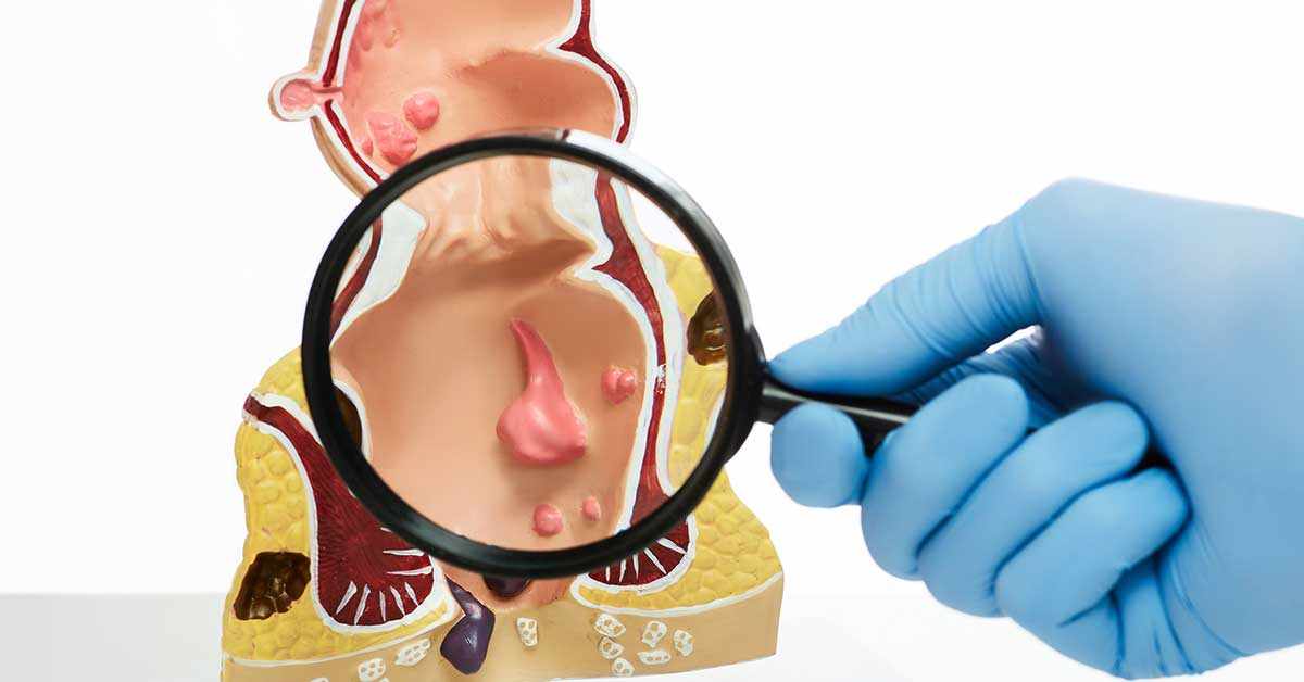 Anal Cancer Market Trends and Growth Dynamics to 2033