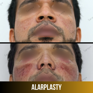 Best Doctor For Alarplasty In Delhi – Enhance Your Nose Shape With Natural Results