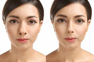 Best Doctor For Alarplasty In Delhi for Natural Nose Reshaping