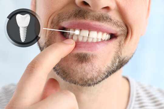 How Much Does a Dental Implant Cost in Hinjewadi in 2026?