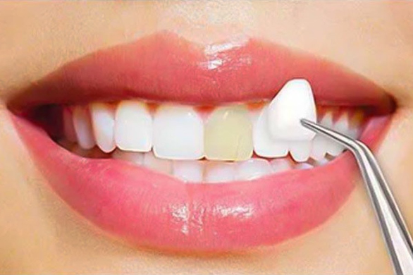 Which Type of Dental Veneers in Hinjewadi Is Best for You?