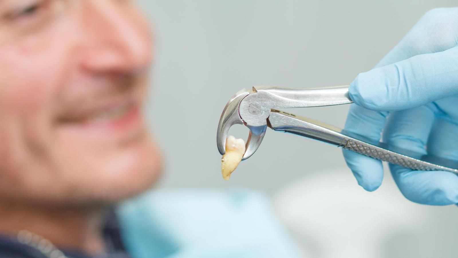 Do All Tooth Extractions Cost the Same? Here’s What Patients Should Know