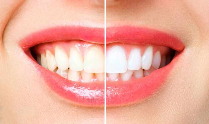 How to Get Rid of Tobacco Stains with Teeth Whitening