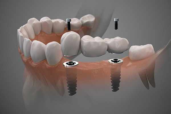 How Many Teeth Can One Implant Support?