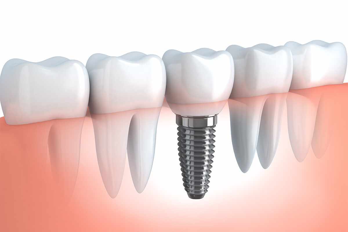 The Impact of Gum Health on Implant Success
