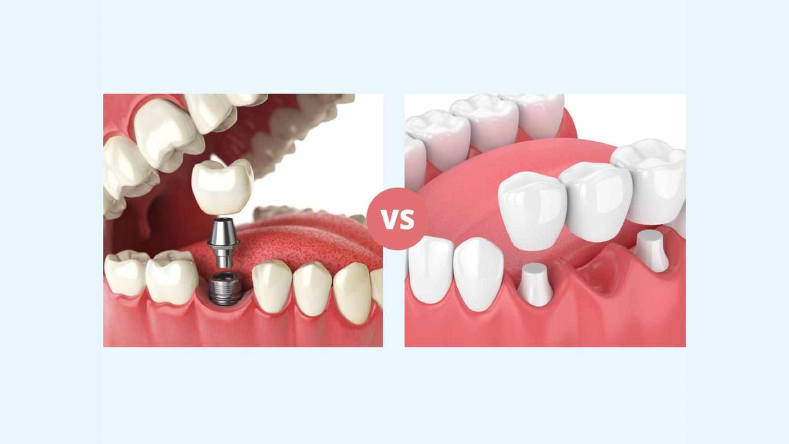 Which Is Better, a Bridge or an Implant?