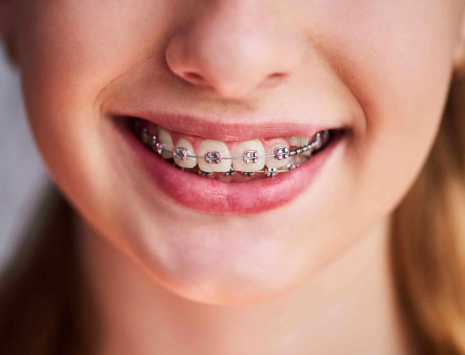 The Right Type of Braces for You