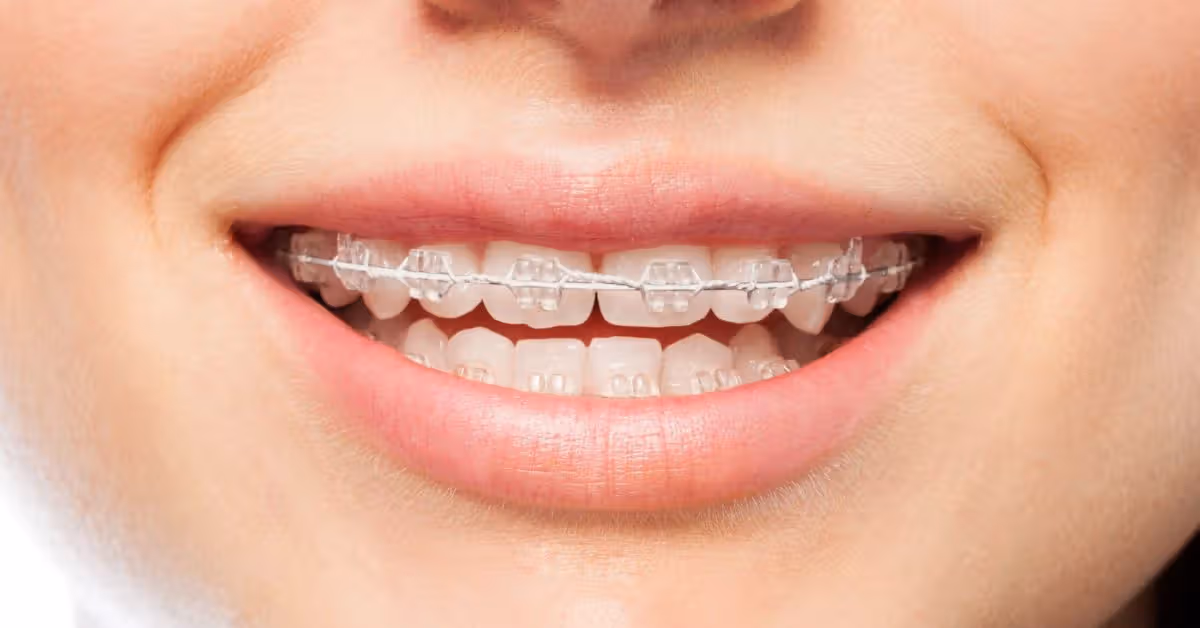 Braces Treatment for Gap Teeth: Step-by-Step Guide