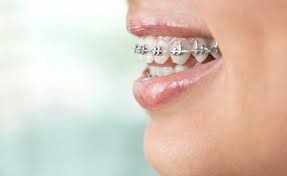 Can Braces Fix Jaw Alignment in Adults | Palm Beach Orthodontics