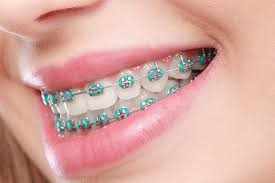 How to Take Care of Braces: Braces Care Tips & Routine by Miami Lakes  Orthodontists