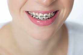 Braces Treatment: Achieve a Healthy and Beautiful Smile