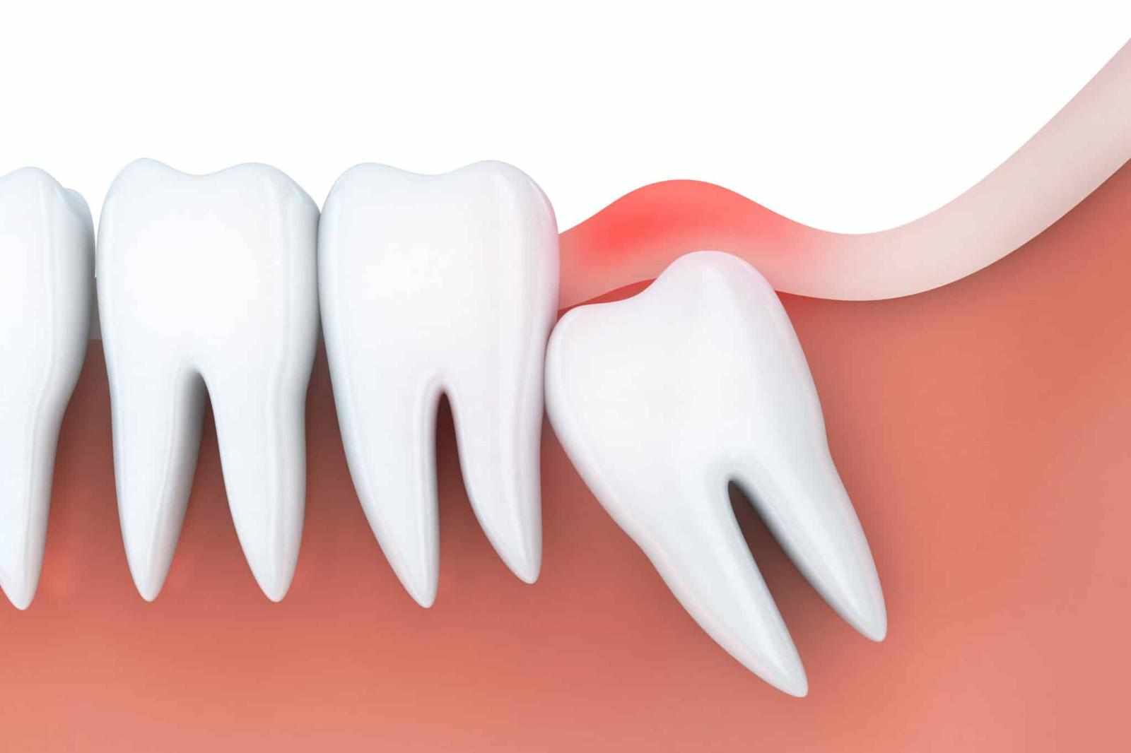 When Is the Right Time for Wisdom Tooth Removal?