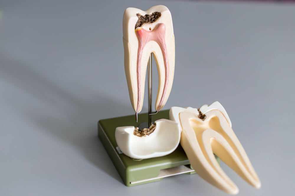 Myths About Root Canals and Root Canal Pain - Coastal Endodontics