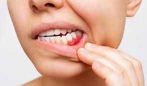 dental implants El Paso TX - Gingival Flap Surgery - A Deep Cleaning For  Your Gums | Bruce Gopin, DDS, MS Periodontics + Implant Surgery