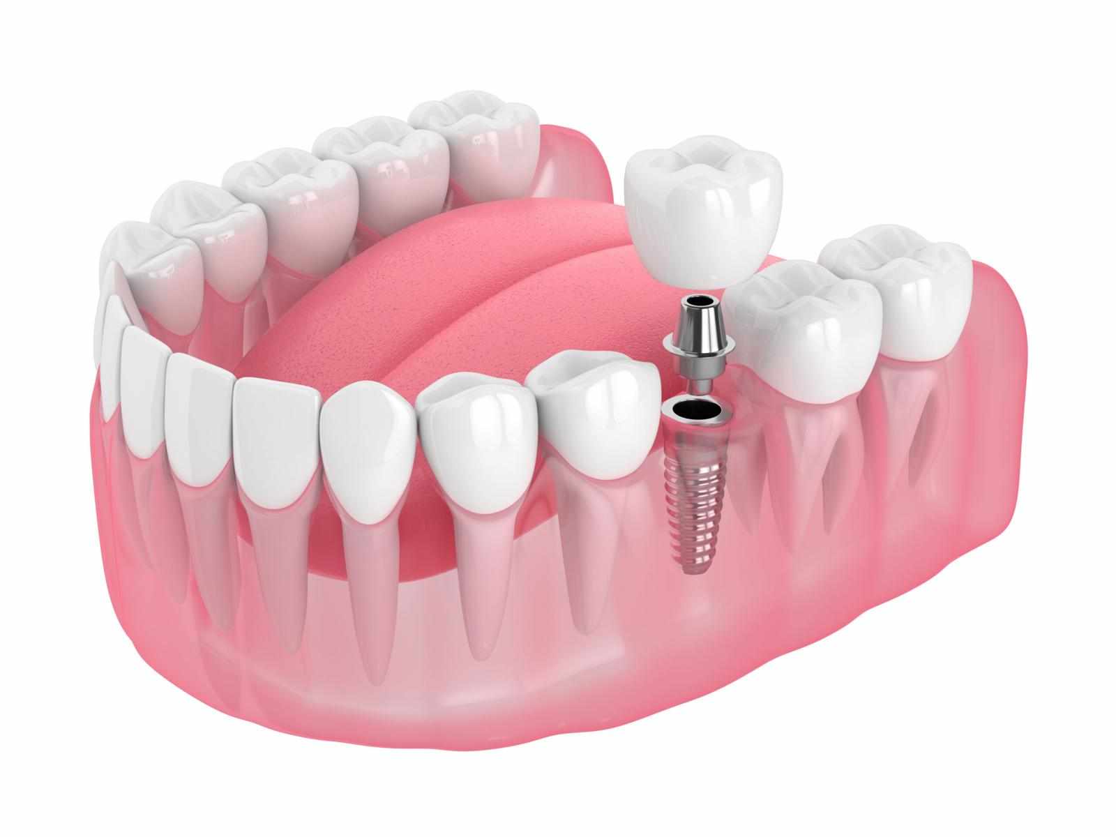 What Are the Top Reasons to Choose Dental Implants? | MaxilloVendome