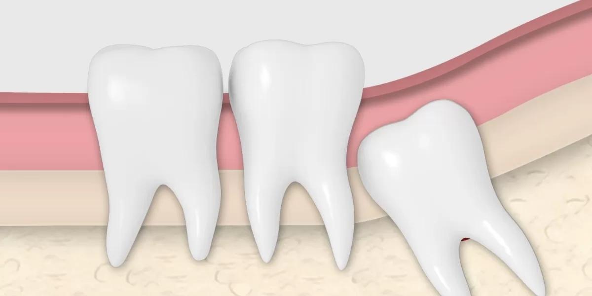 Wisdom Teeth Removal Pasadena | Safe Tooth Extraction for Adults and Teens