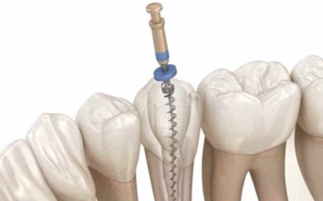 What are the Signs of a Failed Root Canal?