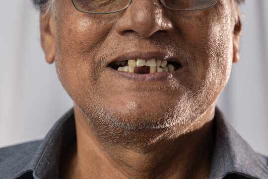 What Happens If You Don’t Replace a Missing Tooth?