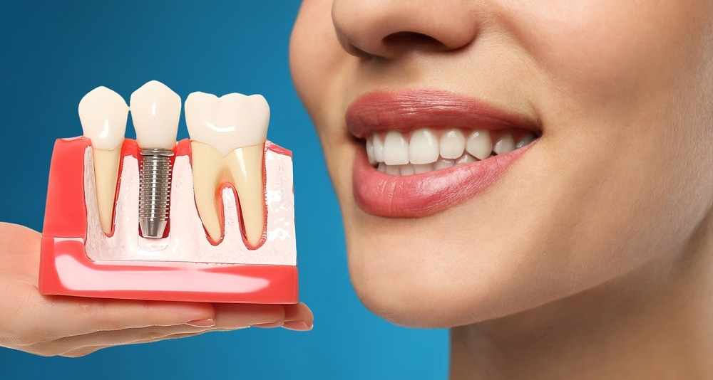 Is the Dental Implant Cost in Bilaspur Worth the Investment?