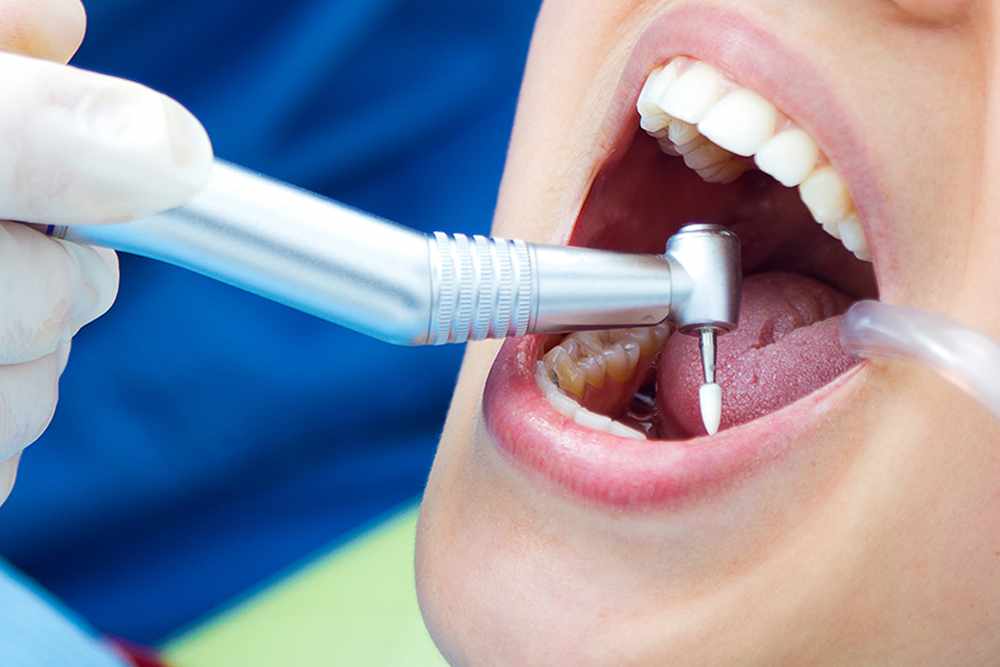 What Happens During a Single Sitting Root Canal Treatment?