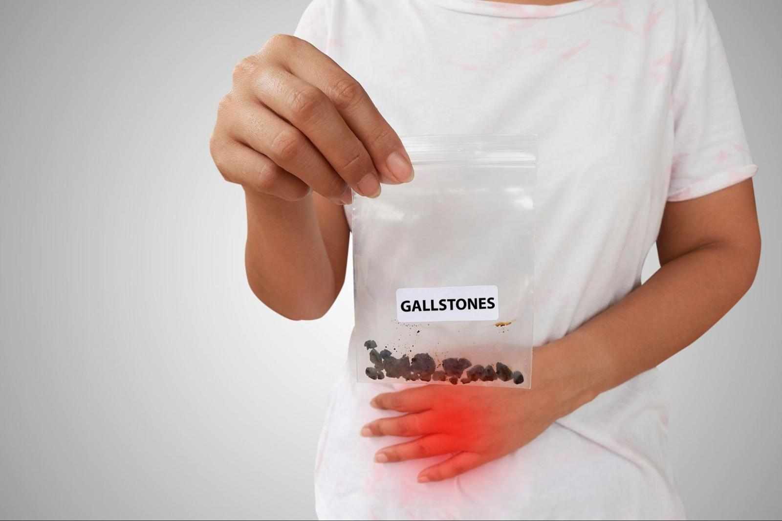 Gallbladder Stone Surgery in Delhi : Expert Advice from the Best GI Surgeon