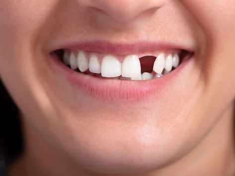 Missing Teeth and Their Impact on Oral Health and Confidence