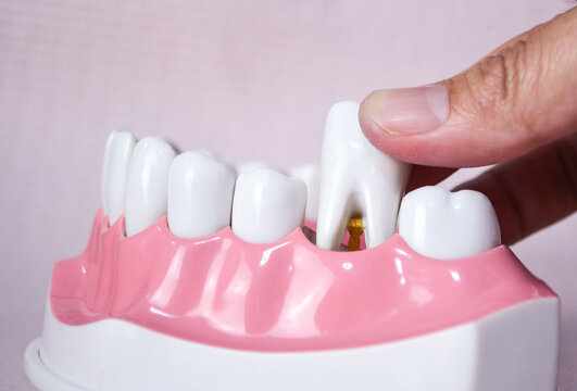 How Much Does Wisdom Tooth Removal Cost and What Affects the Price?
