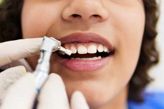 Teeth Cleaning Cost in Nashik: What Is the Average Price & Is It Worth It?