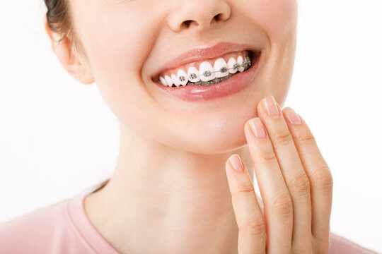 Braces Treatment: How Long Does It Really Take & Why?