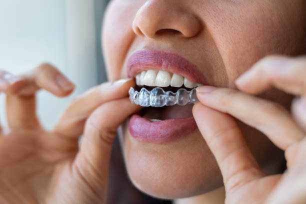 Things to Know Before Starting Invisalign Treatment in Nerul