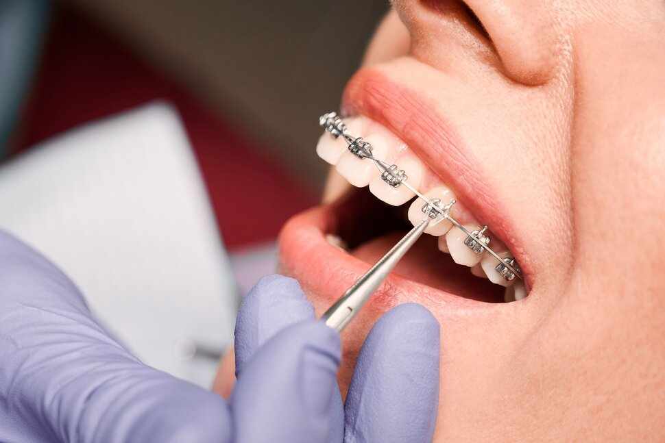 Why More Adults Are Visiting a Braces Specialist in Navi Mumbai Today