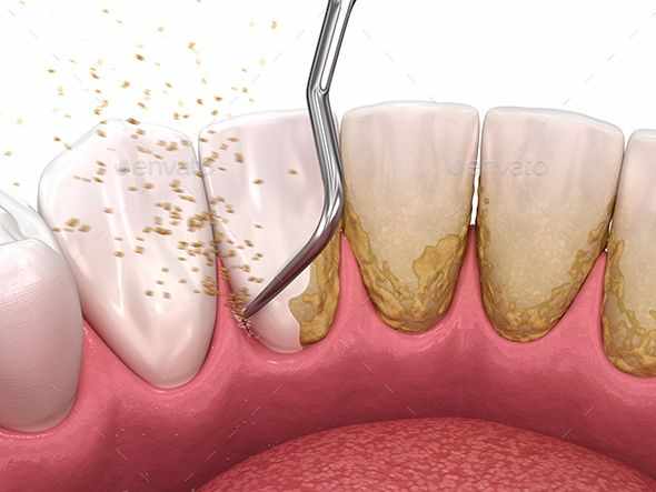 Why Are Teeth Cleaning and Scaling in Navi Mumbai Important Even If You Brush Daily?