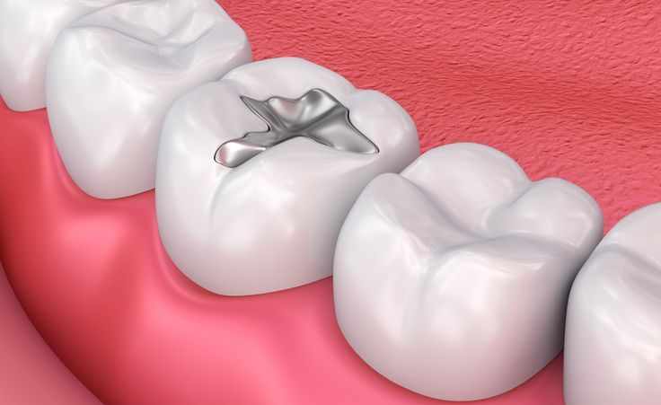 Tooth Filling Cost in Navi Mumbai: Types, Prices & What to Expect