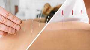 How Acupuncture Supports Urinary Incontinence Management
