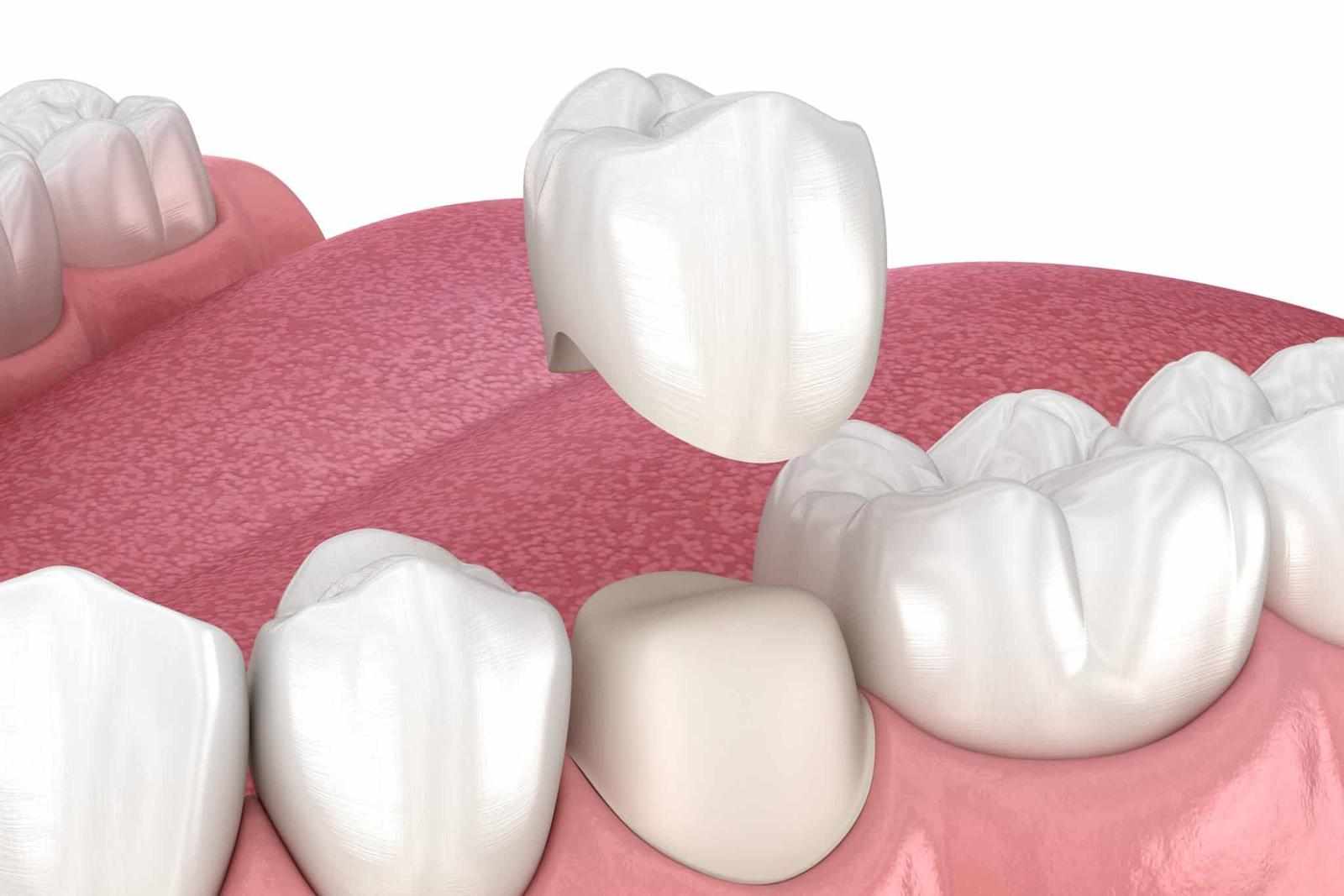 Understanding Your Options and the Dental Crown Cost in Parel Mumbai