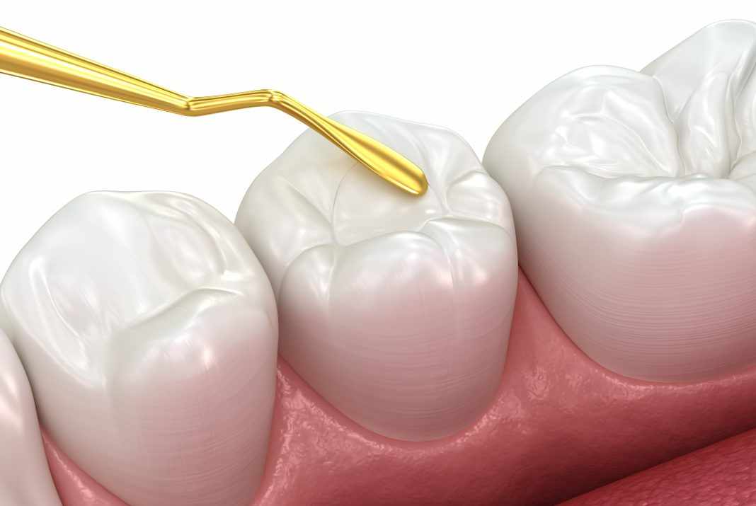 Restoring Your Smile Naturally with Tooth Coloured Filling in Parel Mumbai